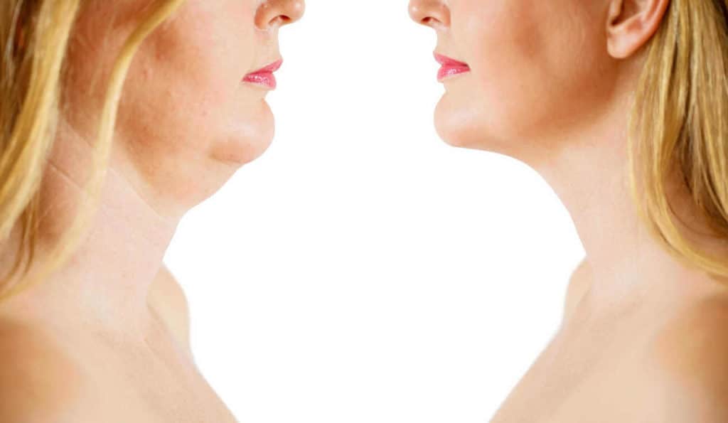 Double Chin treatment Windsor before and after results