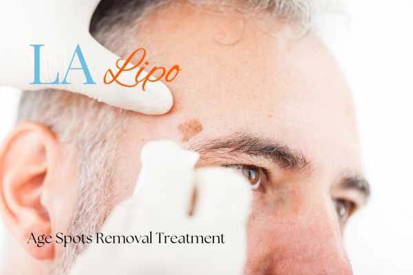 What Are the Most Effective Treatments for Age Spots Windsor?