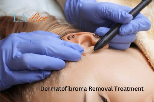 Dermatofibroma Removal Treatment Windsor