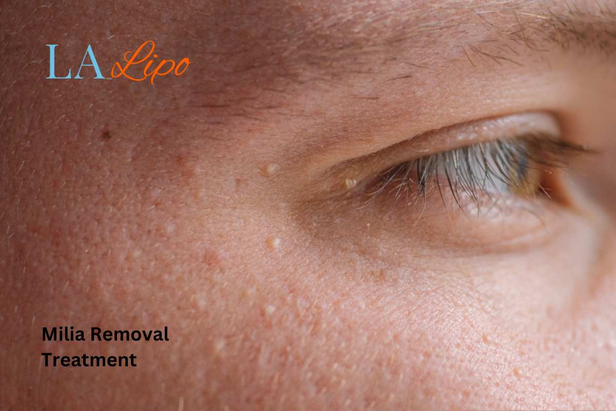 Cryopen Milia Removal: Is It the Easiest and Safest Option Windsor?