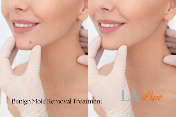 Before-and-after results following benign mole-removal treatment Windsor