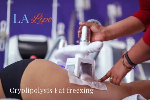 women getting fat freezing Windsor