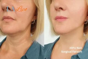 hi-fu for wrinkles Windsor before and after results