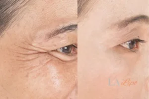 Before and after results of woman - HI-fu wrinkles reduction treatment Windsor