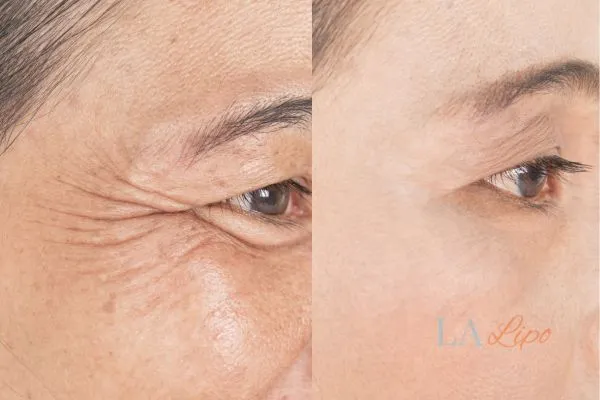 Before and after results of woman - HI-fu wrinkles reduction treatment Windsor