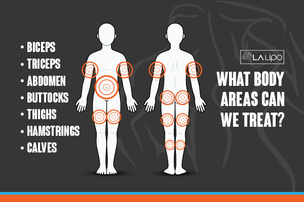Graphic to show areas you can have LA-EMS Body Sculpting Windsor treatment.