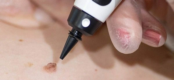 skin tag removal using cryopen Windsor