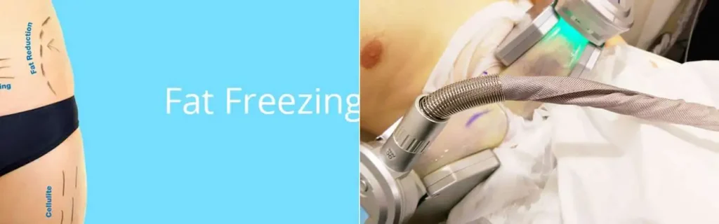 Fat freezing Windsor on multiple areas of the body