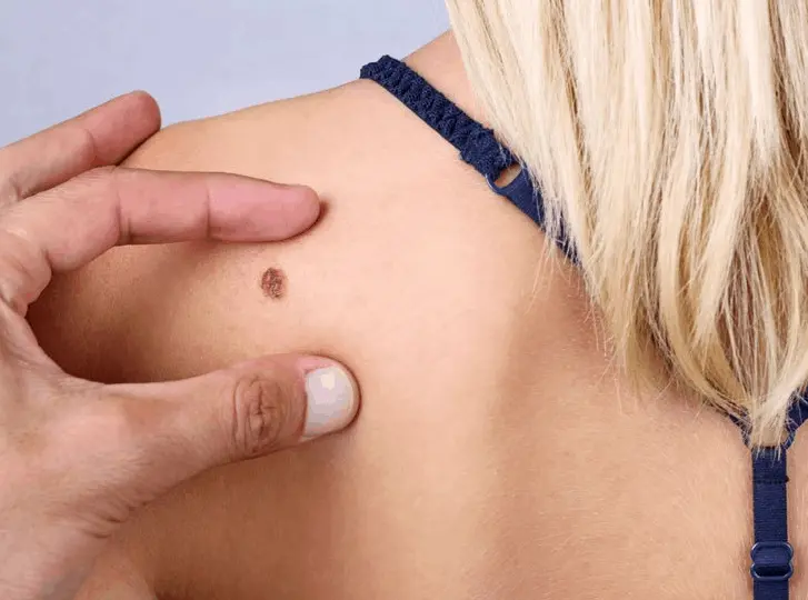 woman having mole removal Windsor consultation before treatment.