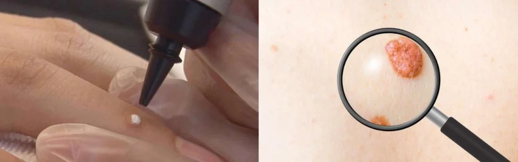 CryoPen practitioner Windsor assessing a benign mole before treatment