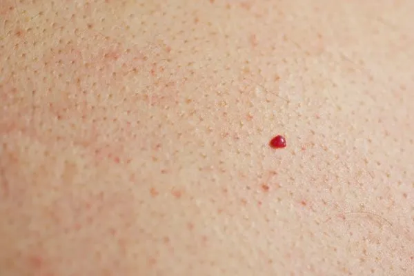 close up of a cherry angioma Windsor