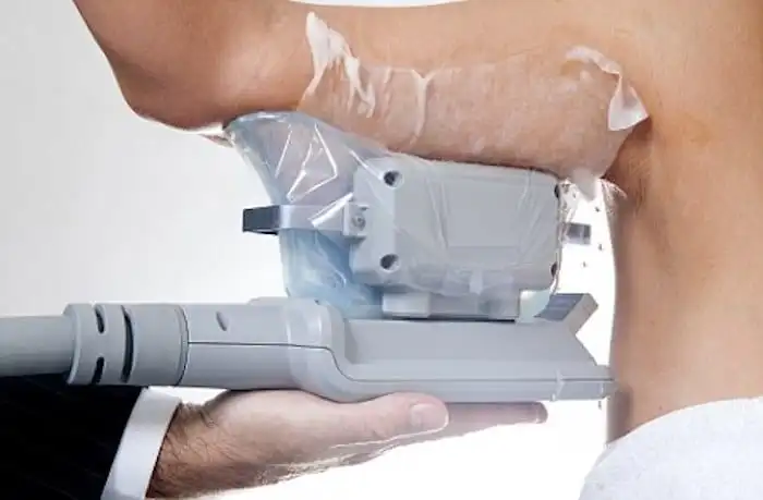 Picture of fat freezing Windsor on the upper arms.