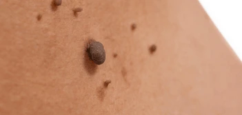 image of a skin tag Windsor