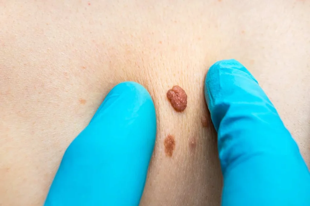 Consultant examining a skin tag Windsor