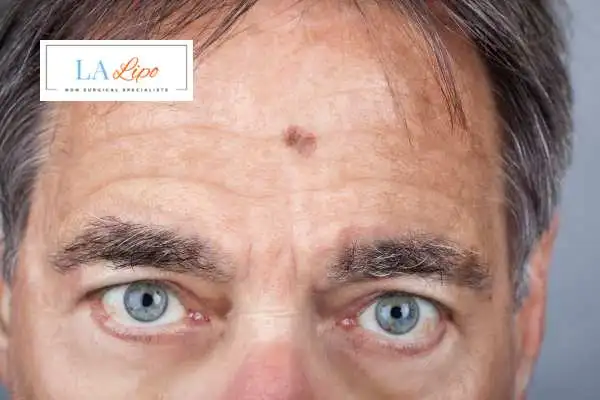 Solar Lentigo Removal Windsor image of man with mark on his forehead