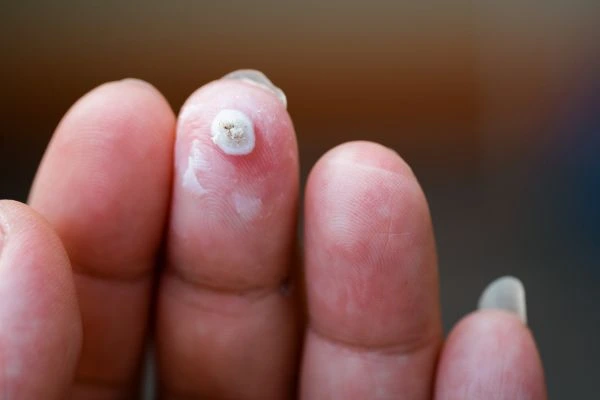 wart on person finger - cryotherapy to treat from LA LIPO Windsor