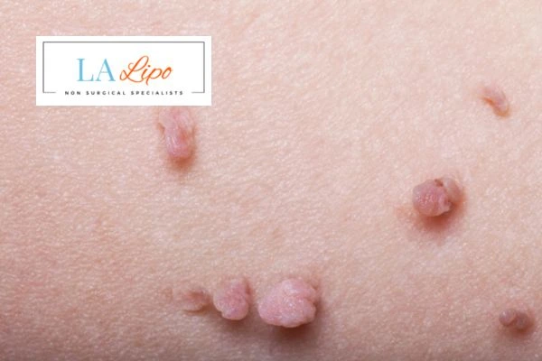 Does cryopen skin tag removal Windsor hurt? Find out now call our team today!