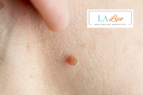 Book skin tag removal Windsor today speak to our team now!