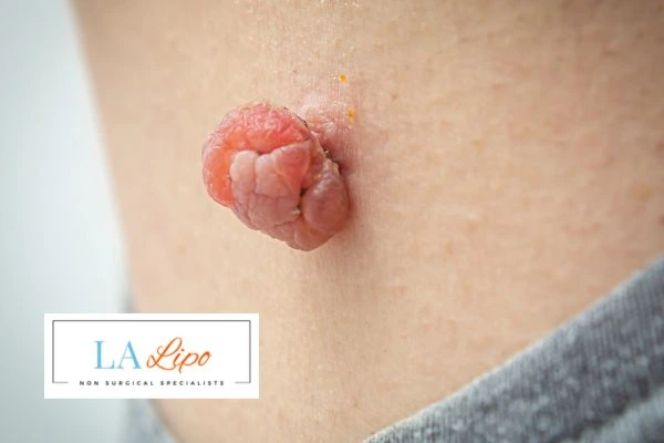 Interested in skin tag removal Windsor? Concerned about the pain? Find out more today!