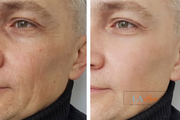 See the amazing results of Morpheus8 Treatment Windsor!