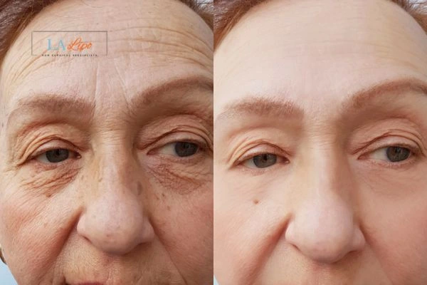 The powerful benefits of Morpheus8 Treatment Windsor - Call Our team today!