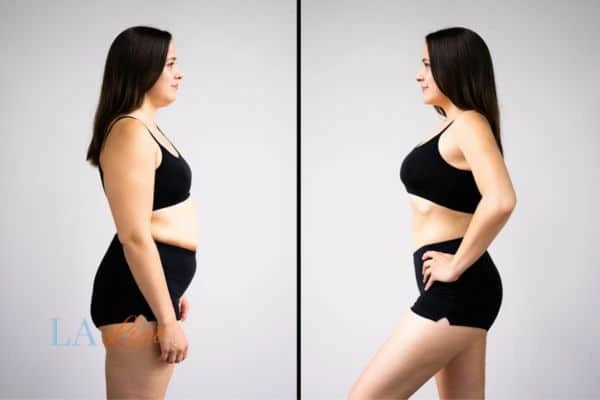 Picture of womans before and after using LA-EMS body sculpting to improve her core strength Windsor