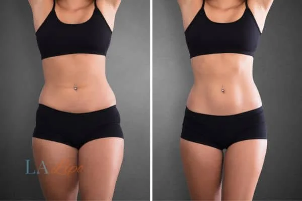 before and after results of non-surgical treatment to help a woman's body image and mental health Windsor