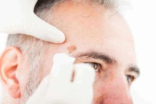 Age spots and elderly people Windsor what is the link?