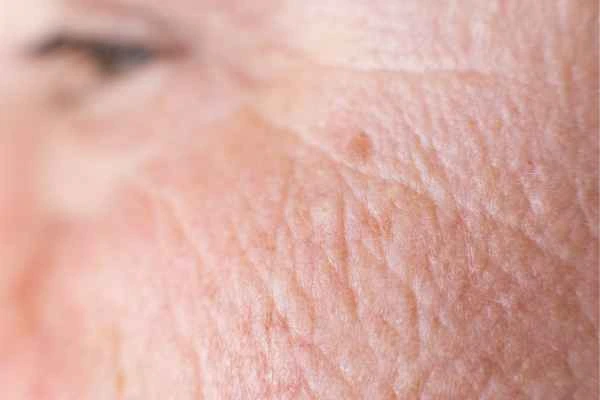 close up picture of a woman's face showing an age spot Windsor