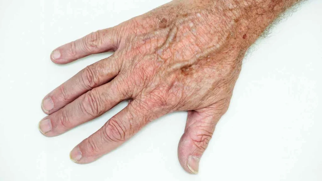 Male hand showing age spot Windsor