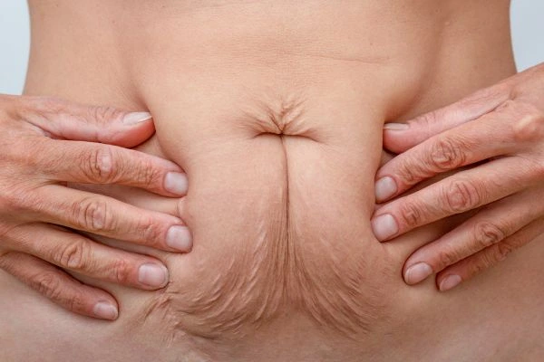 Image of a woman's stomach with loose skin - example of skin tightening Windsor options