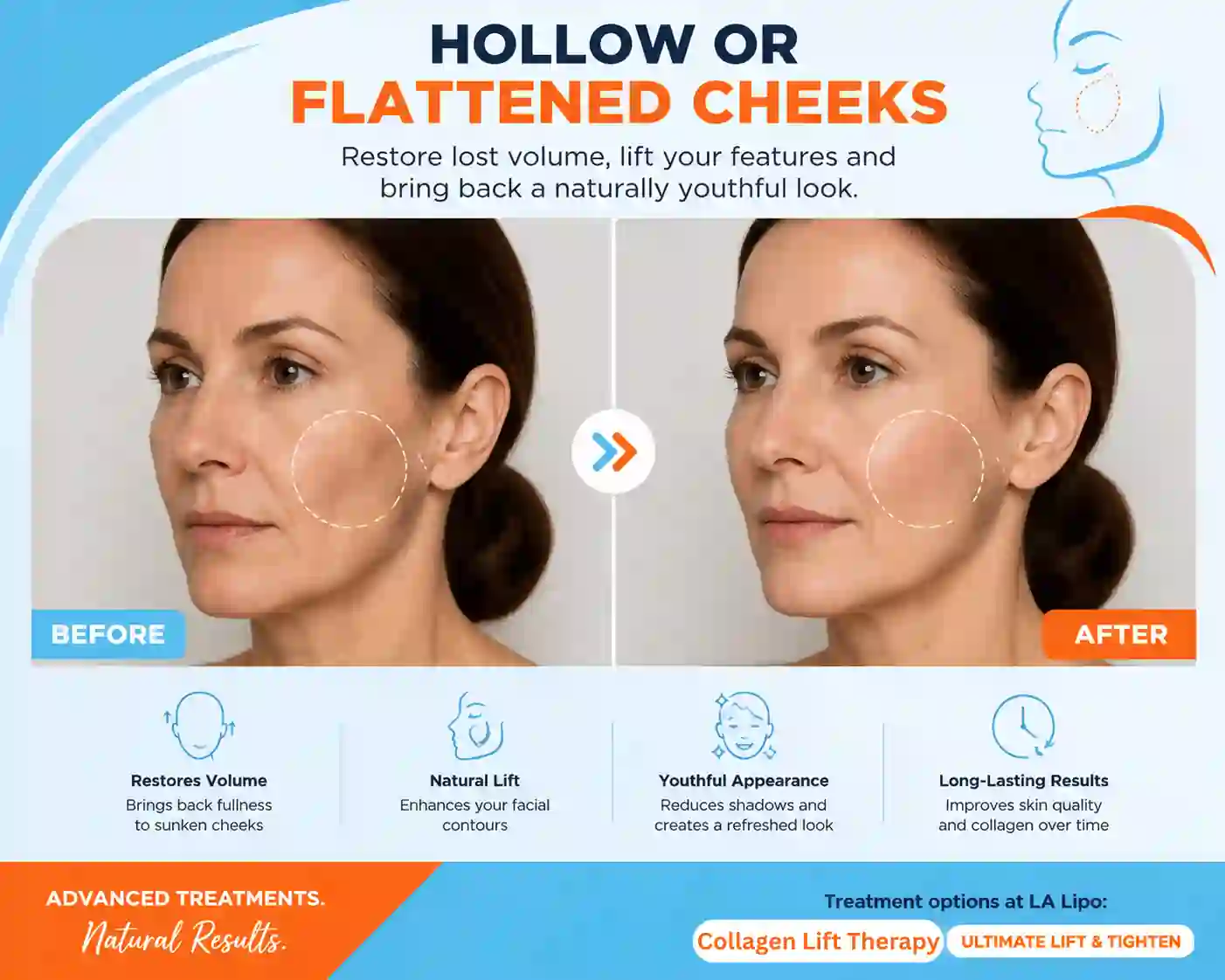 Sign #4: Hollow or Flattened Cheeks Windsor