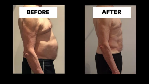 What Symptoms Can Diastasis Recti Cause in Men? Weak Core, Back Pain and Poor Posture Windsor